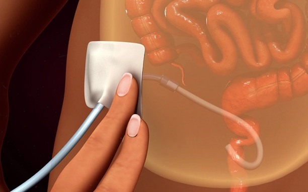Dialysis Catheter